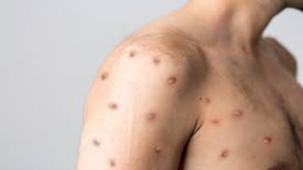 What is monkeypox. symptoms, danger signs, treatments, and methods of the virus transmission 2 monkeypox-1