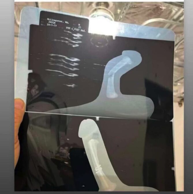 Human Penis Has No Bone & Cannot Break. Photo Xray Of Broken Penis Fake 2 Human Penis Has No Bone & Cannot Break. Photo Xray Of Broken Penis Fake